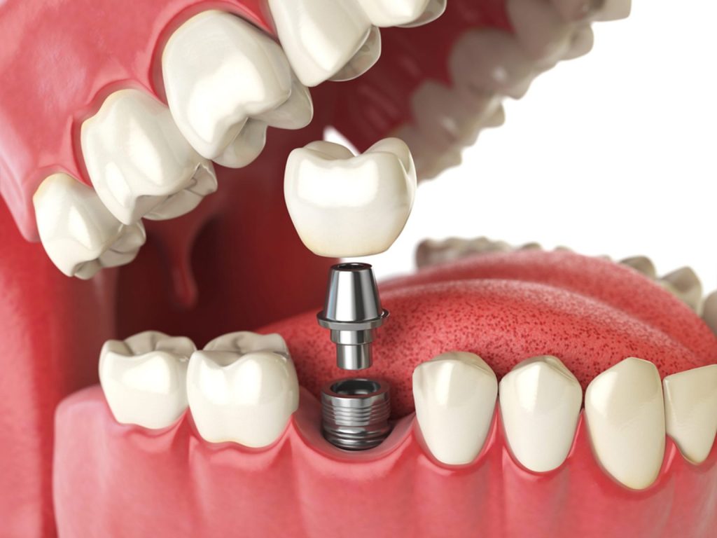 Possible Substitutes for Dental Implants