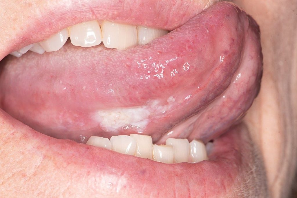 Regular Oral Cancer